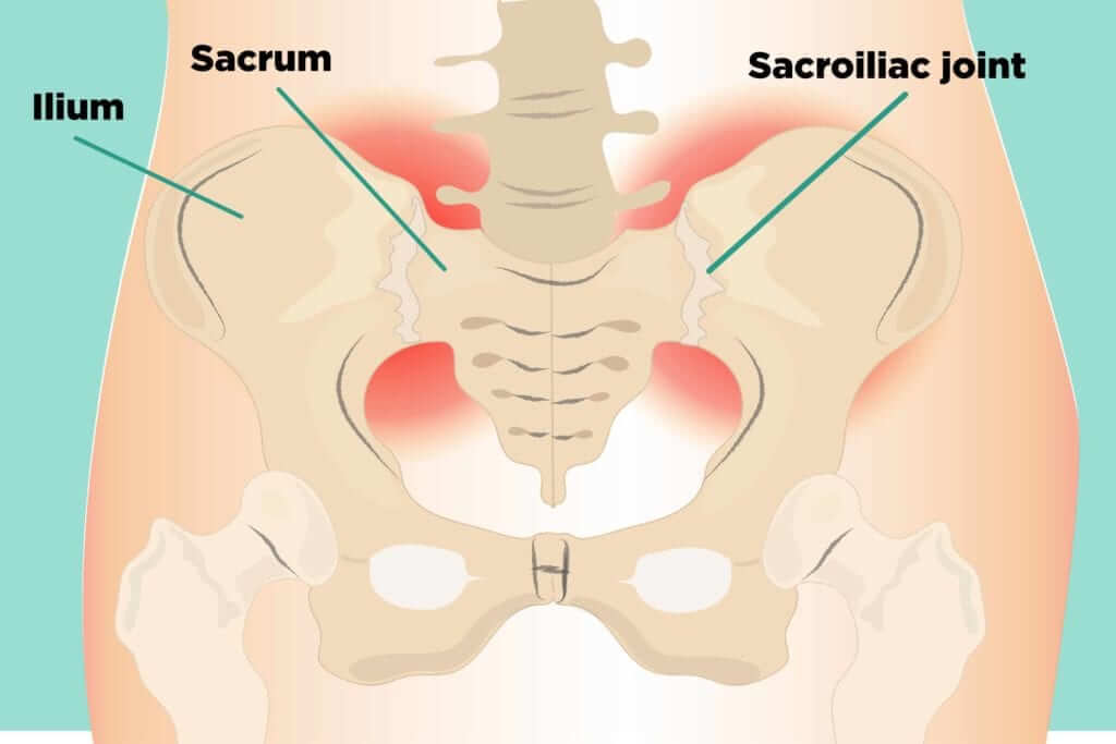 What is Sacroiliitis, Causes, symptoms, and treatment?